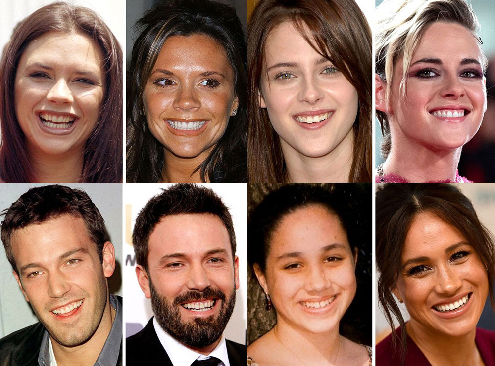 Fuqia e dhëmbëve: Si u transformuan këta të famshëm vetëm prej buzëqeshjes