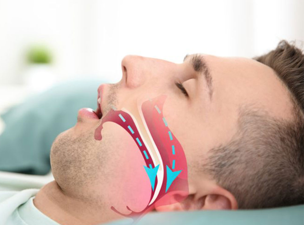 Çfarë është apnea e gjumit dhe cilat janë simptomat?