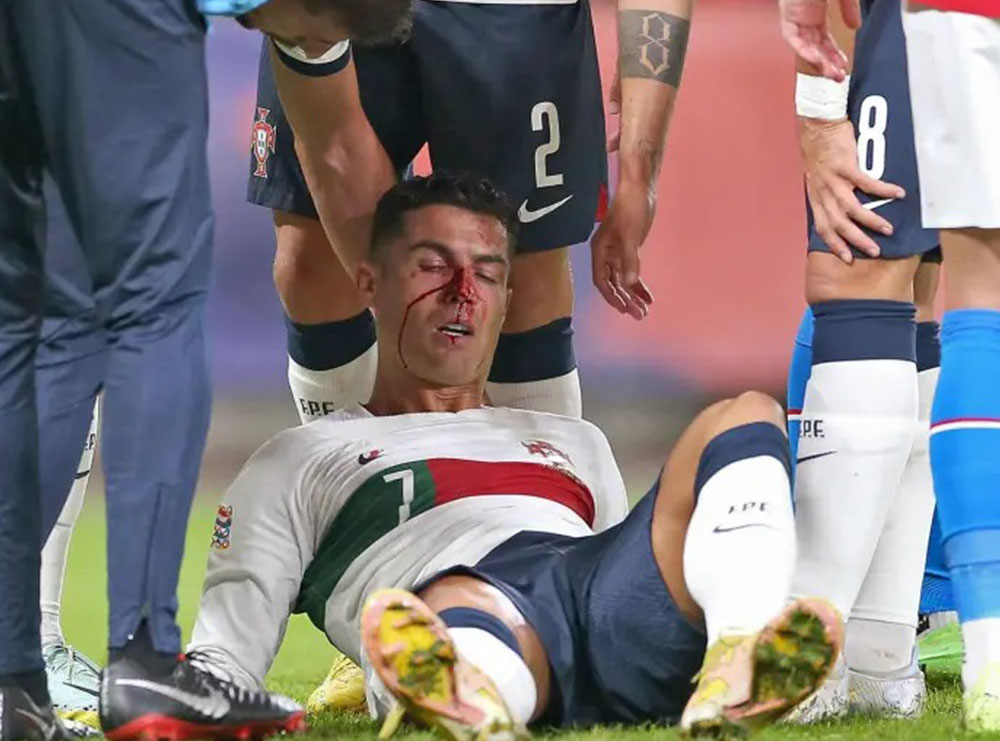 Dëmtohet rëndë Cristiano Ronaldo/Portieri çek i thyen hundën në fushë!