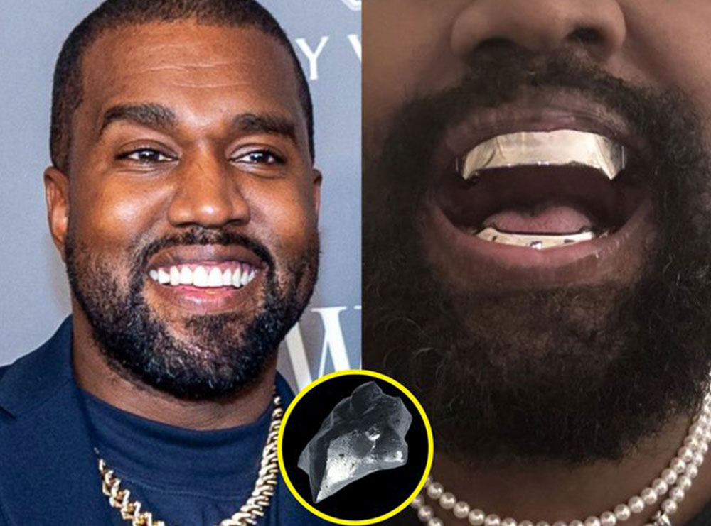 Buzëqeshja e Kanye West tani kushton 850 mijë dollarë, reperi heq dhëmbët dhe vendos proteza më të shtrenjta se diamanti